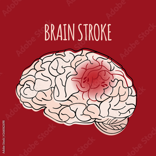 BRAIN STROKE Insult Apoplexy Medicine Health Danger Treatment Therapy Banner Poster Vector Illustration
