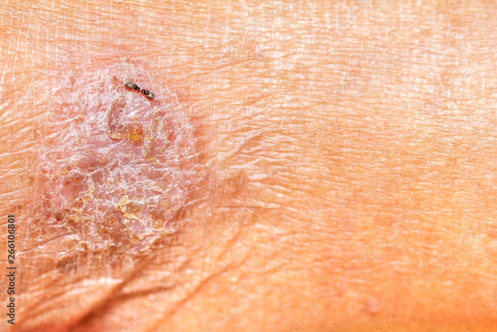 Fototapeta premium Close up blisters of the old man's ,feet Infection of the outer epidermis. Skin diseases