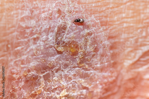 Konstfotografi Close up  blisters of the old man's ,feet Infection of the outer epidermis