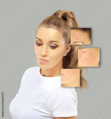 Post-Acne Marks /Treating Acne Scars.Acne Scar Removal