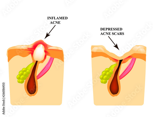 Inflamed acne on the skin. Inflamed pimple. The structure of the skin. Acne scar.