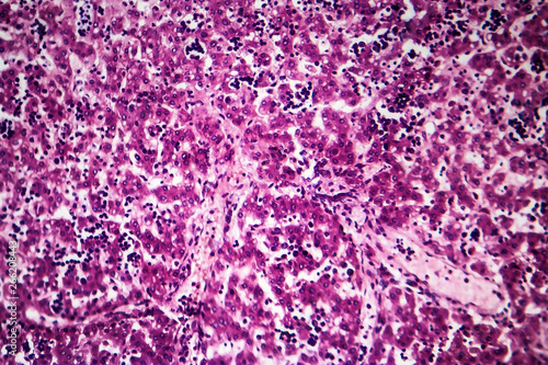 Histopathology of chronic active hepatitis, light micrograph, photo under microscope