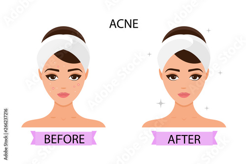 Girl has acne on her face. Before and after. Concept of skincare, pure and healthy skin. Vector illustration.
