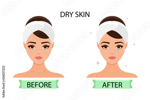 Girl has dry skin on her face. Before and after. Concept of skincare, pure and healthy skin. Vector illustration.
