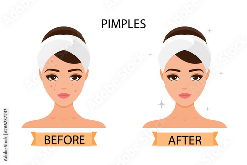 Girl has pimples on her face. Before and after. Concept of skincare, pure and healthy skin. Vector illustration..