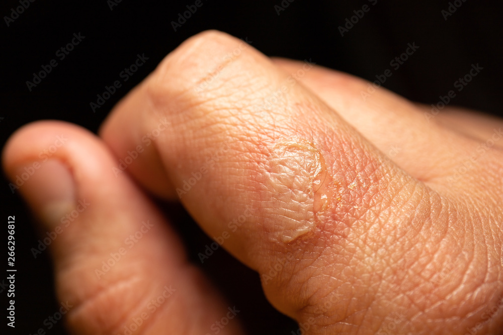 Burning wound of forefinger in detailed macro image. Detail of injury by fire or hot iron. Burning wound of forefinger in detailed macro image. Detail of injury by fire or hot iron.