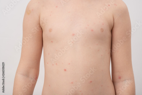 Chickenpox, also known as varicella, is a highly contagious disease caused by the initial infection with varicella zoster virus