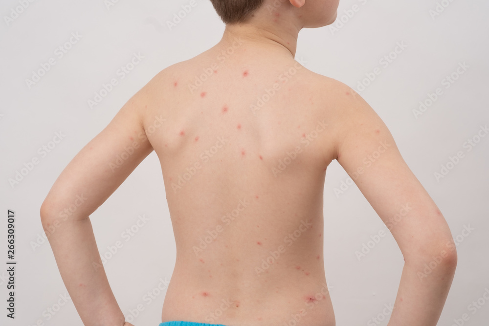 Fototapeta premium Closeup of back of boy with Varicella virus or Chickenpox. Bubble rash on child.