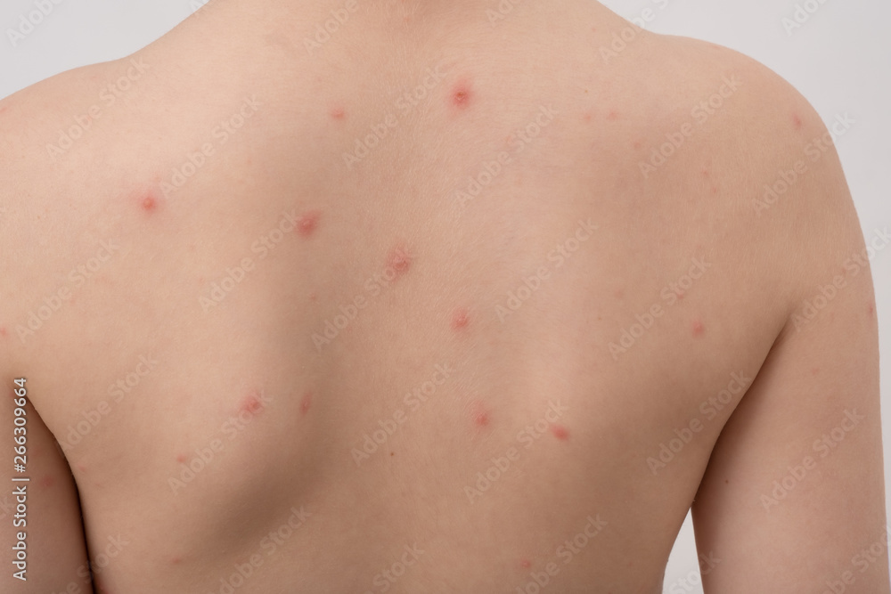 Closeup of back of boy with Varicella virus or Chickenpox. Bubble rash on child. Closeup of back of boy with Varicella virus or Chickenpox. Bubble rash on child.