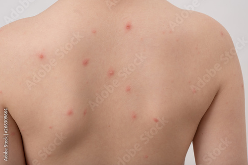 Closeup of back of boy with Varicella virus or Chickenpox. Bubble rash on child.