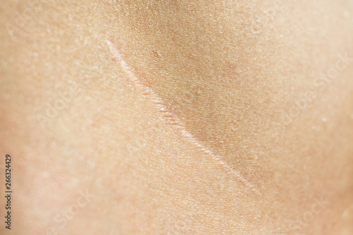 Photo Close-up, beautiful surgical scar on the skin after appendectomy