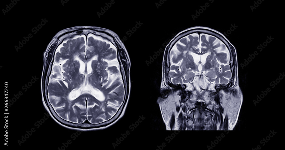 Comparison MRI of the brain Axial and Coronal plane for detect a variety of conditions of the brain such as cysts, tumors, bleeding, swelling, developmental and structural abnormalities, infections. Comparison MRI of the brain Axial and Coronal plane for detect a variety of conditions of the brain such as cysts, tumors, bleeding, swelling, developmental and structural abnormalities, infections.