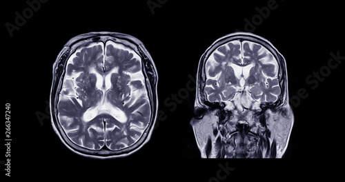 Comparison MRI of the brain Axial and Coronal  plane for detect a variety of conditions of the brain such as cysts, tumors, bleeding, swelling, developmental and structural abnormalities, infections.