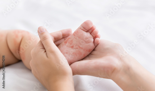 Mother holding tiny baby foot with measles rash