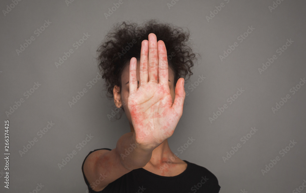 Stop Measles Virus. African Woman With Red Spots On Palm - obrazy, fototapety, plakaty 