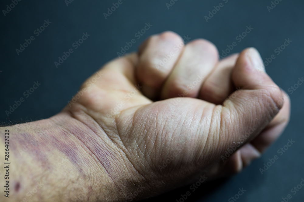 Fist closed, man's arm with bruises on his hand and wrist. Fist closed, man's arm with bruises on his hand and wrist.