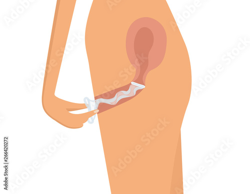 Female condom withdrawal