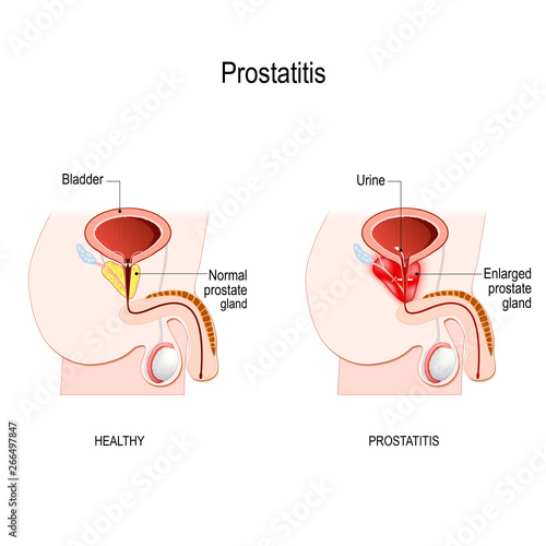 Prostatitis. swelling and inflammation of the prostate gland
