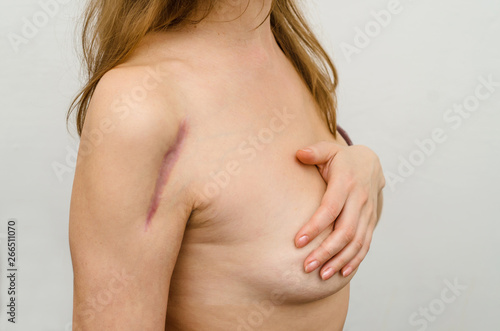 Right shoulder female  large scar at the top of the shoulder on the deltoid muscle after surgery setting a metal plate on the bone