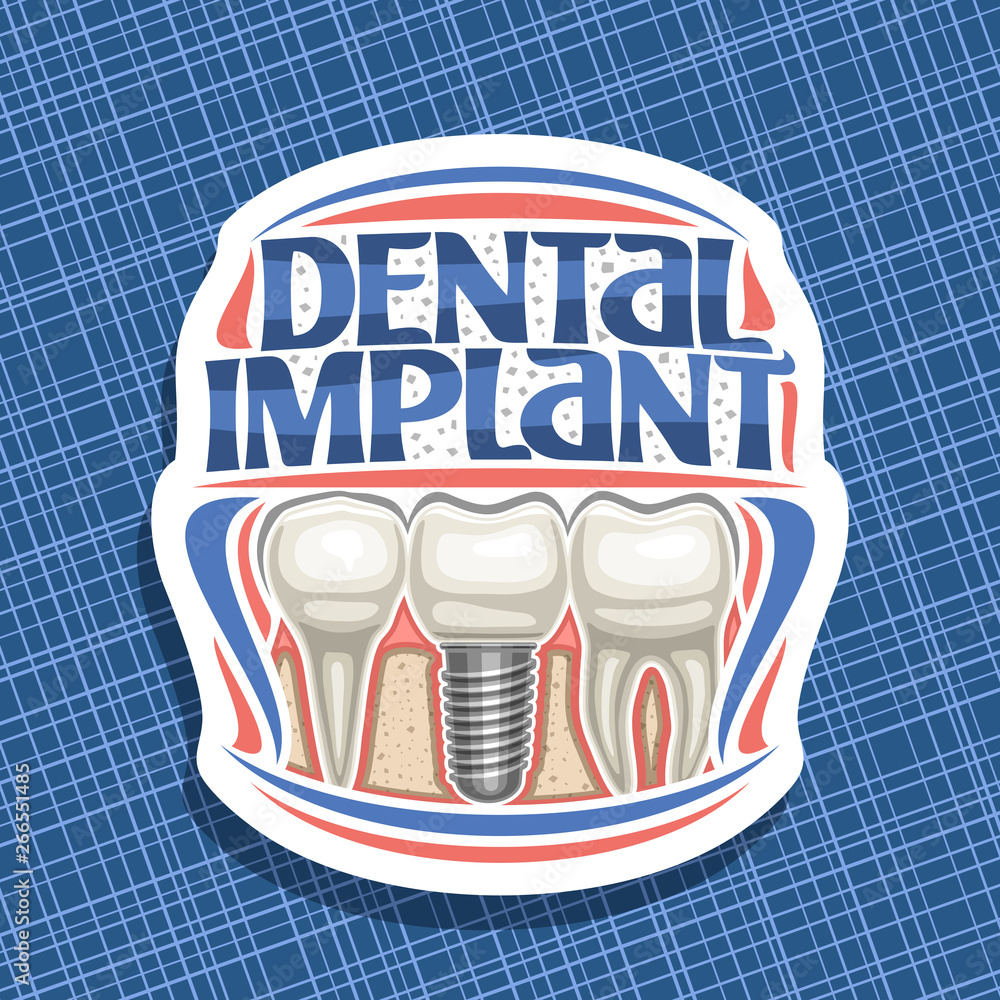 Vector logo for Dental Implant, white decorative badge with 3 cartoon ...
