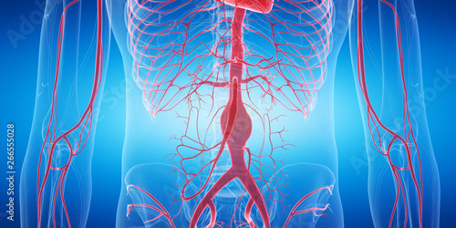 3d rendered medically accurate illustration of an aneurysm photo