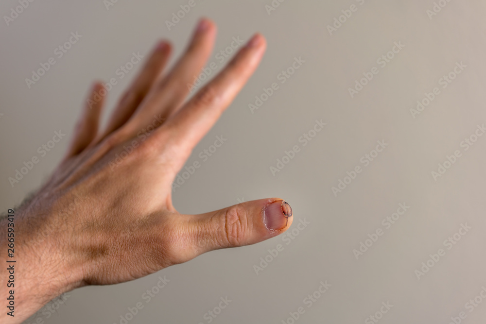 Thumb finger cut with sharp knife while cooking, home injury medical attention, nail cut Thumb finger cut with sharp knife while cooking, home injury medical attention, nail cut