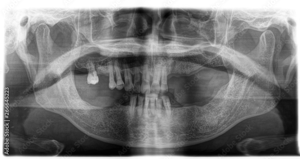 X ray of human mouth with teeth bones in black and white. Detail of panoramic facial x-ray image