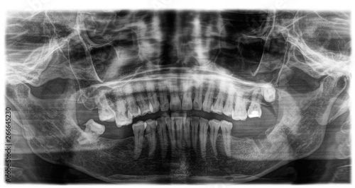 X ray of human mouth with teeth bones in black and white. Detail of panoramic facial x-ray image