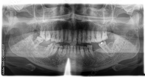 X ray of human mouth with teeth bones in black and white. Detail of panoramic facial x-ray image
