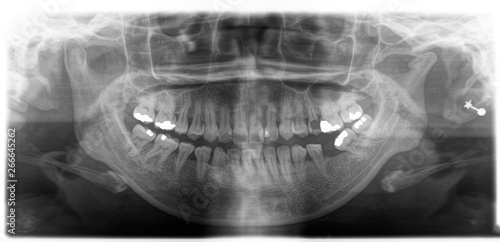 X ray of human mouth with teeth bones in black and white. Detail of panoramic facial x-ray image