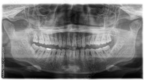 X ray of human mouth with teeth bones in black and white. Detail of panoramic facial x-ray image