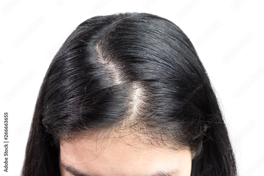 women head with dandruff Caused by the problem of dirty. Or caused by skin disease or Seborrheic Dermatitis. It has white scaly and it will cause itch. women head with dandruff Caused by the problem of dirty. Or caused by skin disease or Seborrheic Dermatitis. It has white scaly and it will cause itch.