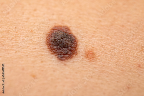 Dangerous nevus on skin - melanoma photo