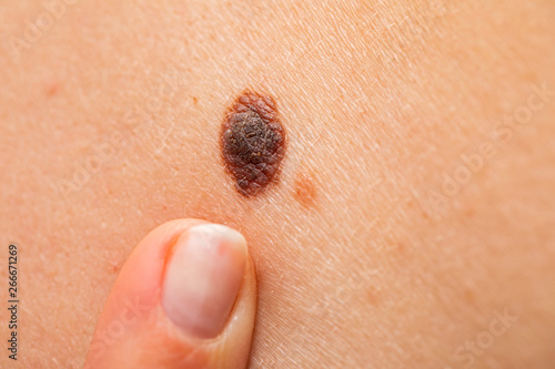 Dangerous nevus on skin - melanoma photo