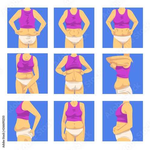 Part of Female Overweight Body Set, Human Figure After Weight Loss, Front, Back and Side View, Obesity and Unhealthy Eating Problems Vector Illustration