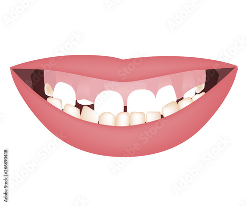 Kids mouth with a too big mandible and high smile line or gummy smile before the orthotropics or orthotropics treatment. Underbite dental occlusion