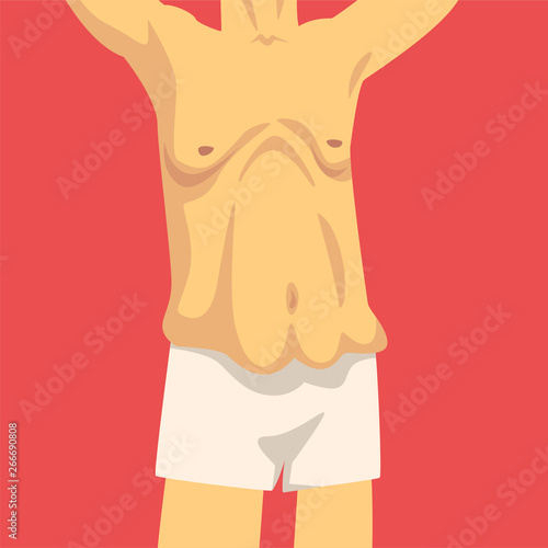 Male Torso with Sagging Belly, Human Body After Weight Loss, Front View, Obesity and Unhealthy Eating Problems Vector Illustration