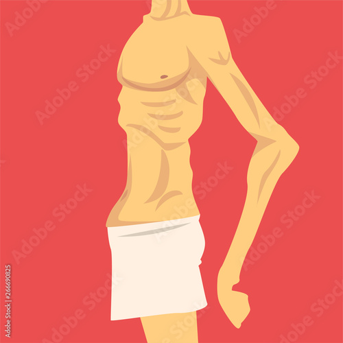 Male Torso with Short Weight and Sagging Belly, Human Body After Weight Loss, Side View, Obesity and Unhealthy Eating Problems Vector Illustration