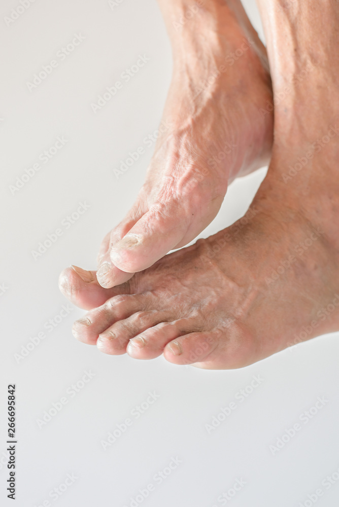 Fototapeta premium Both feet that are degraded according to the physical condition