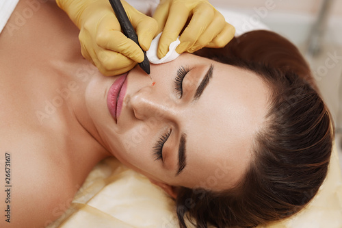 Electrocoagulation of vessels on the face