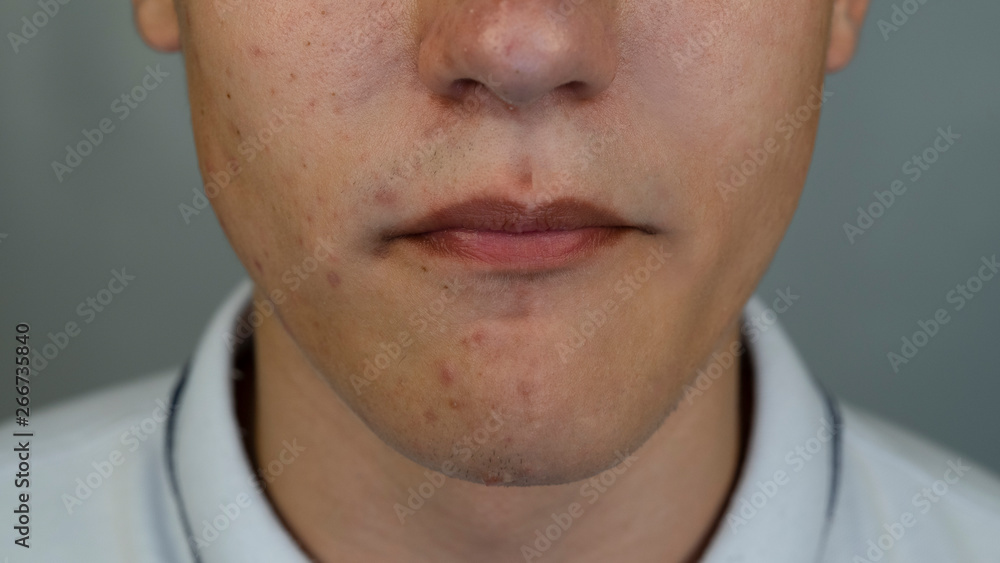Boy with pimples and acne on the face. Close up Boy with pimples and acne on the face. Close up