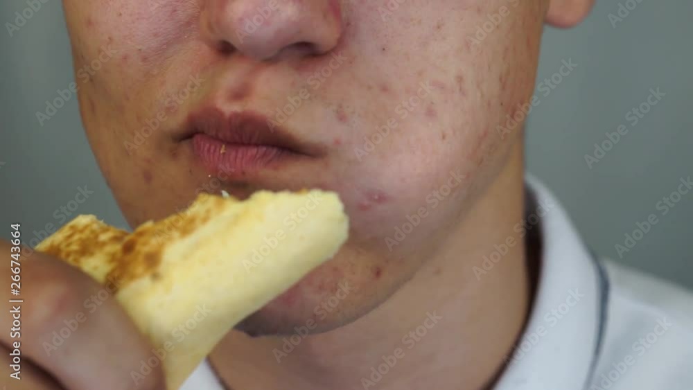 Teenager with pimples and acne on face is eating junk food, close up Teenager with pimples and acne on face is eating junk food, close up