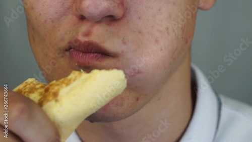Teenager with pimples and acne on face is eating junk food, close up