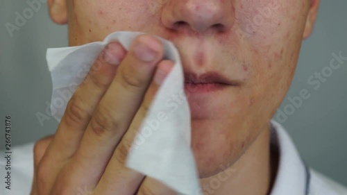 The young man wipes his face with a wet wipe after eating. Close up