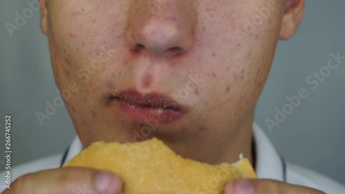 Young man with pimples and acne on the face is eating the chicken burger. Close up.