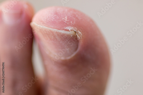 Big Toe with Ingrown Toenail, Scaly, Dry Skin and Cracking