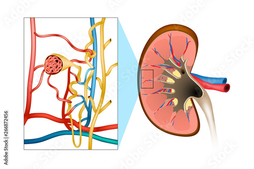 Glomerulonephritis (GN). Inflammation either of the glomeruli or of the small blood vessels in the kidneys.