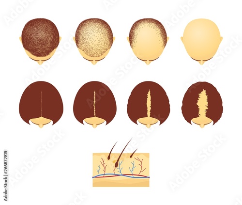 Set of male and female heads in top view with hair loss cartoon style