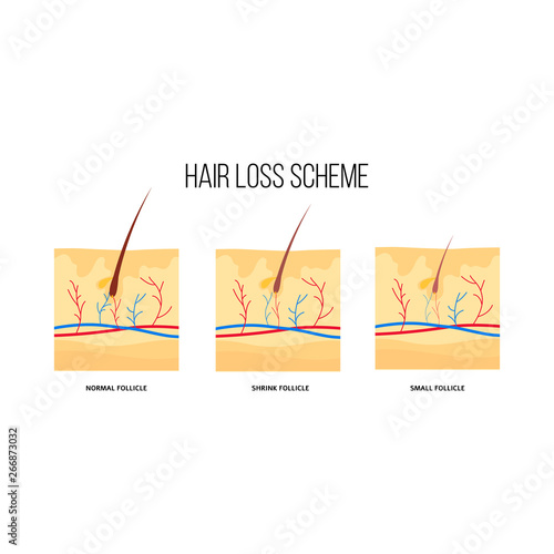 Human hair loss scheme flat style
