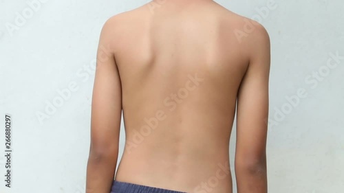 Asian kid with scoliosis